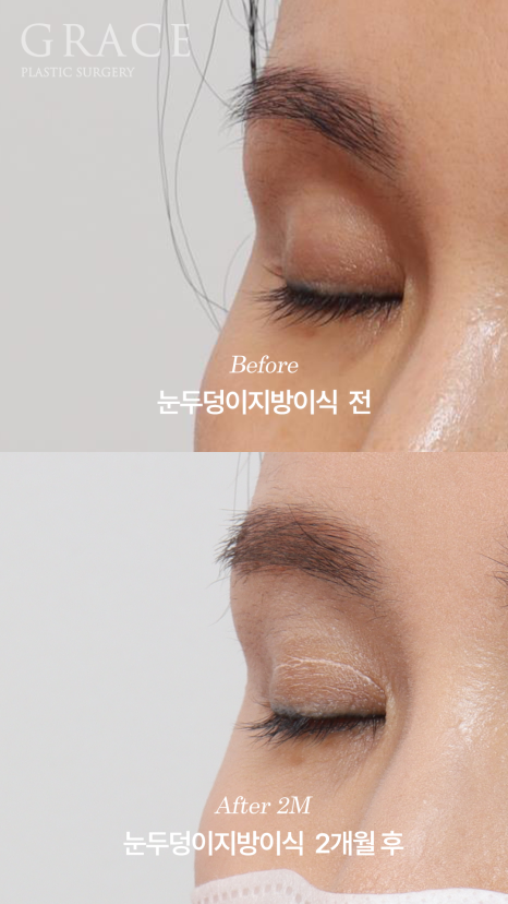 Will Swelling After Eyelid Fat Grafting Last a Long Time... Is It Really True? image 4