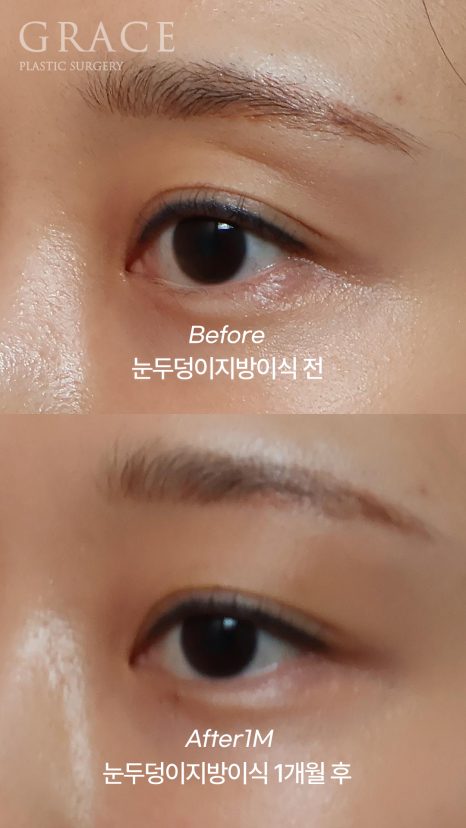 눈두덩이 꺼짐 개선을 위한 지방이식 관련 이미지 3
