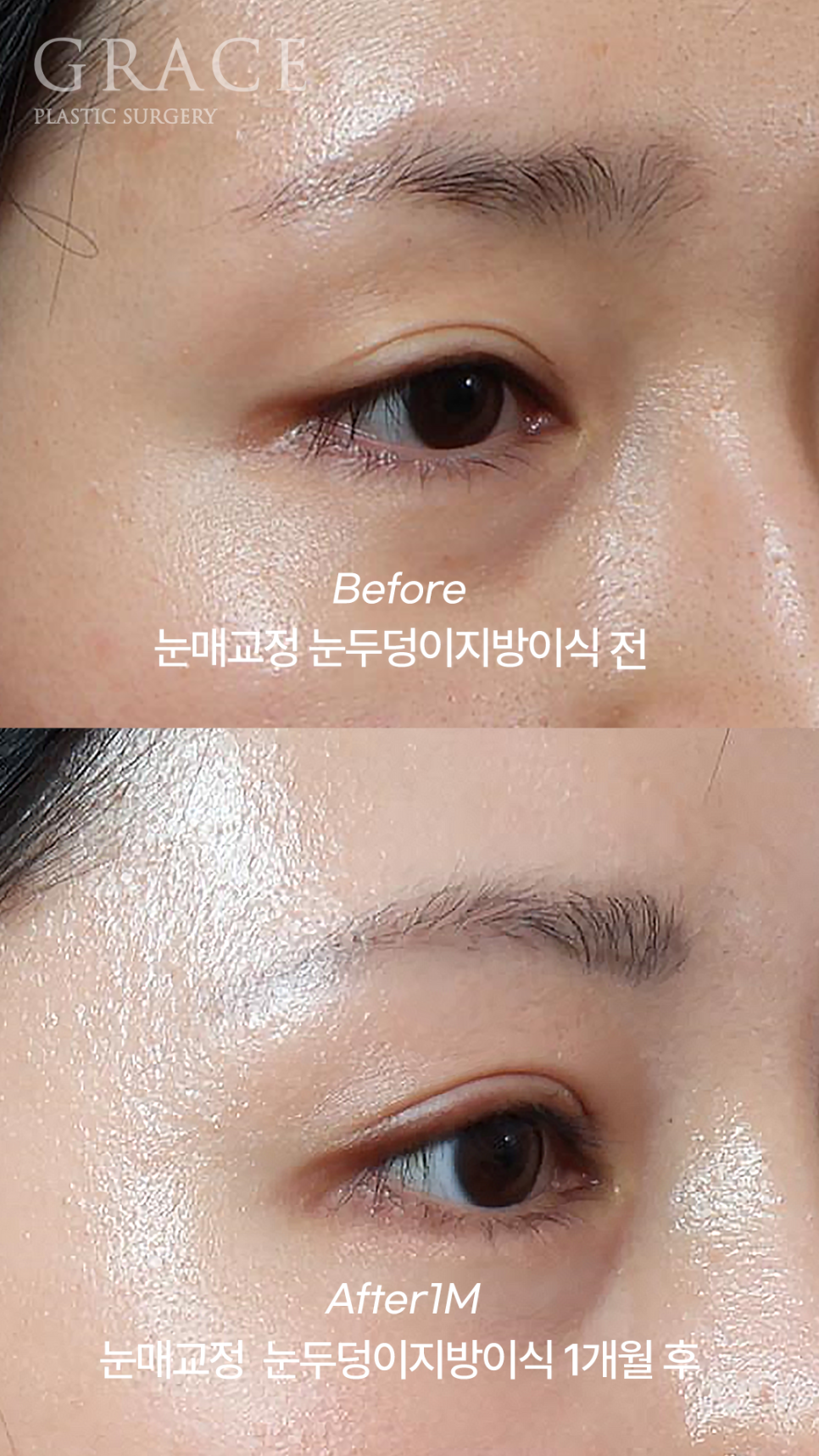 20대 후반 절개눈매교정+눈꺼풀지방이식 관련 이미지 5