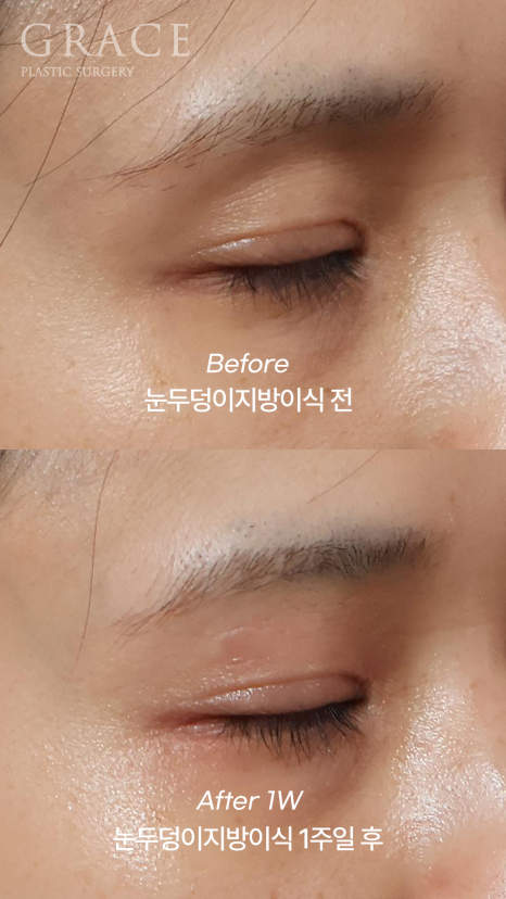 눈꺼풀 지방이식 눈 감았을 때 울퉁불퉁하지 않는 이유 전후사례로 보여드립니다 관련 이미지 3