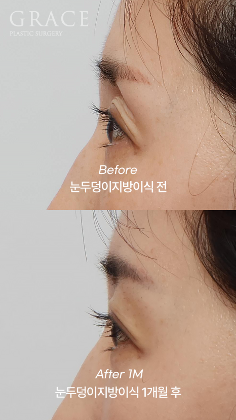 Eyelid Fat Grafting Side Effects? How to Settle In Beautifully Without Lumps image 12