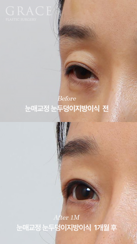 눈성형 부작용 후 재수술 안검하수 교정과 눈두덩이지방이식 1개월 경과 관련 이미지 4