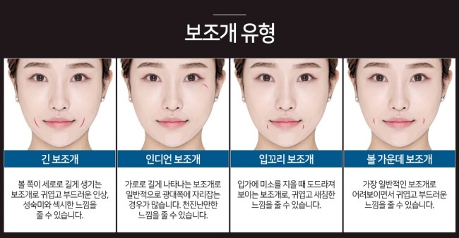 심심한 내 얼굴에 예쁜 포인트를 주는 보조개수술 관련 이미지 4