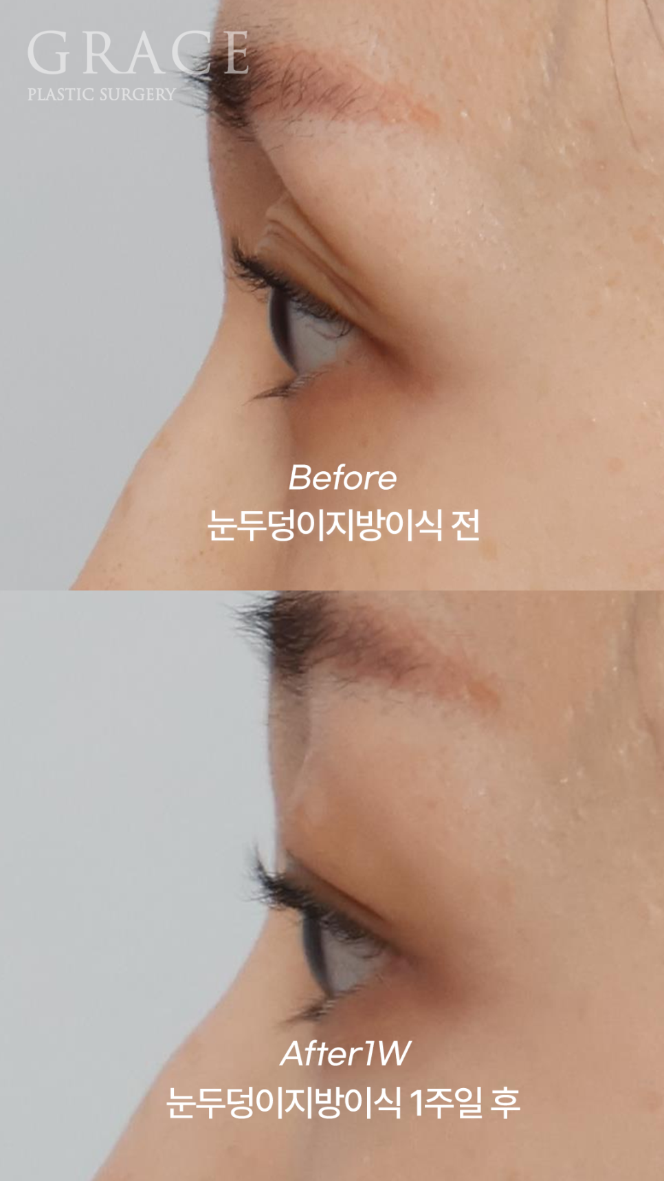 Sunken Eyelid Fat Grafting: Swelling After 1 Week Before & After image 9