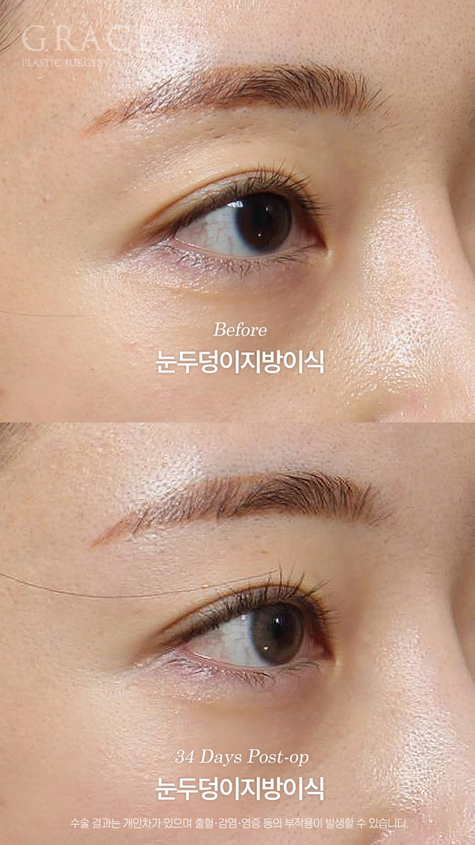 눈두덩이 지방이식이 필요한 경우 진료실에서는 무엇을 볼까요? 관련 이미지 4