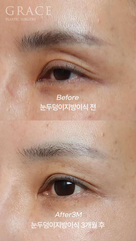 Grace Plastic Surgery 40s Case: Improved Eye-Opening Strength After Upper Eyelid Fat Grafting image 4