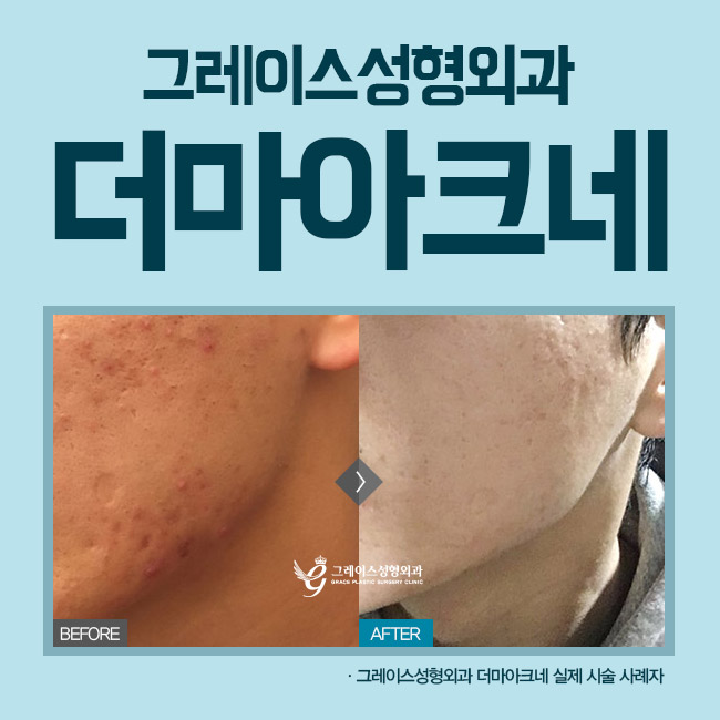 더마아크네 피지선을 파괴해 여드름을 끝내다 관련 이미지 1