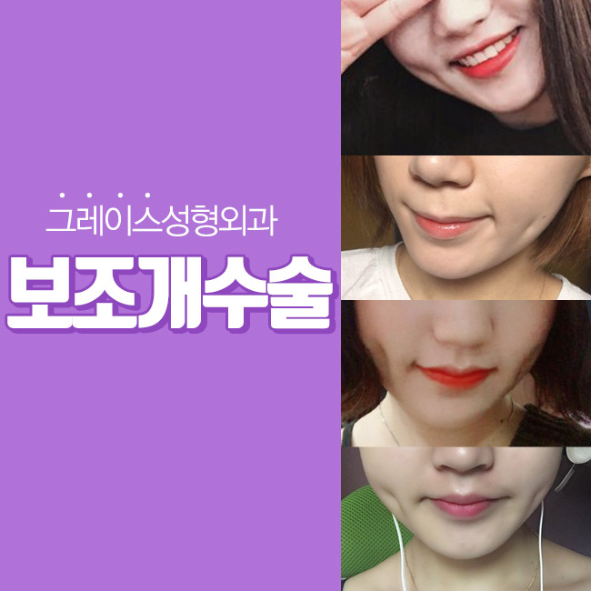 예쁜 웃음의 포인트! 보조개수술 그레이스성형외과에서 관련 이미지 2