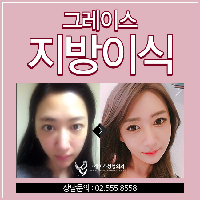 노안을 벗어나는 방법! 그레이스성형외과 얼굴지방이식후기 관련 이미지 2