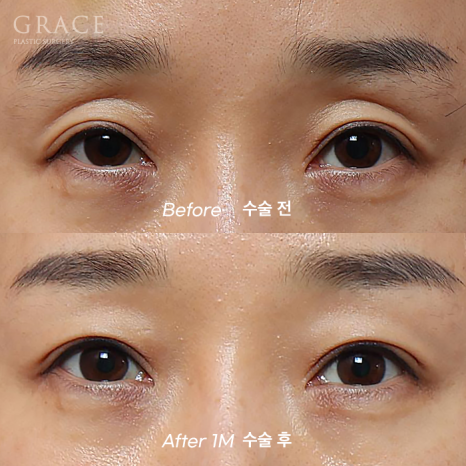 Concerns About Swelling and Side Effects After “Eye Hollow Fat Grafting” Surgery in the Eye Socket Area for People in Their 60s image 15
