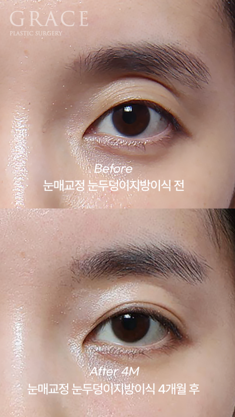 Review of 1cc Eyelid Fat Grafting for Sunken Upper Eyelids (Mid-30s, 4 Months Post-op Swelling and Scarring) image 8