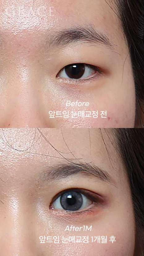 개강 후 난리 났다! 20살 눈매교정 앞트임 전후 관련 이미지 3