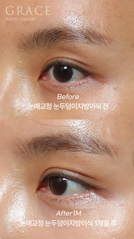 Side Effects of Eyelid Fat Grafting? One-Month Engraftment Period When Eyelid Correction Is Performed image 5