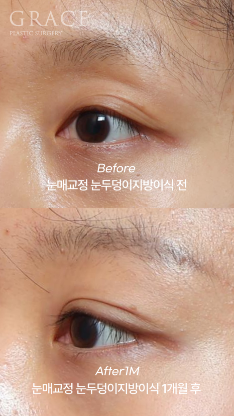 꺼진 눈두덩이 필러 대신 지방이식? 붓기&middot;부작용 없는 방법 정리 관련 이미지 4