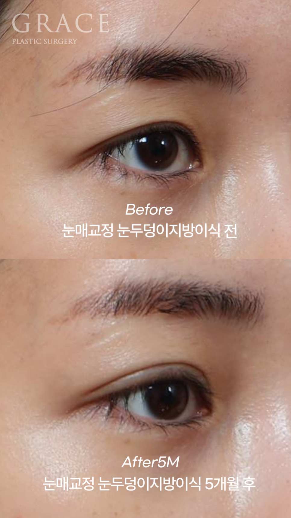 Introduction to a Case of Upper Eyelid Fat Grafting After Correction of Uneven Eyes image 7
