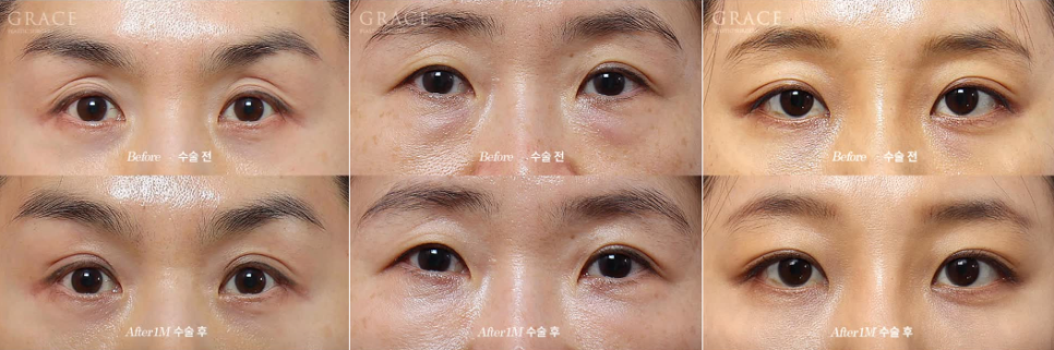 Before and After Eyelid Fat Grafting for Sunken Eye Hollows | Grace Plastic Surgery image 4