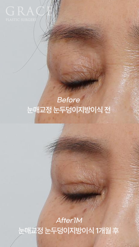 Is Upper Blepharoplasty Necessary at 58? Swelling Side Effects After Non-Incisional Ptosis Correction and Upper Eyelid Fat Grafting image 7