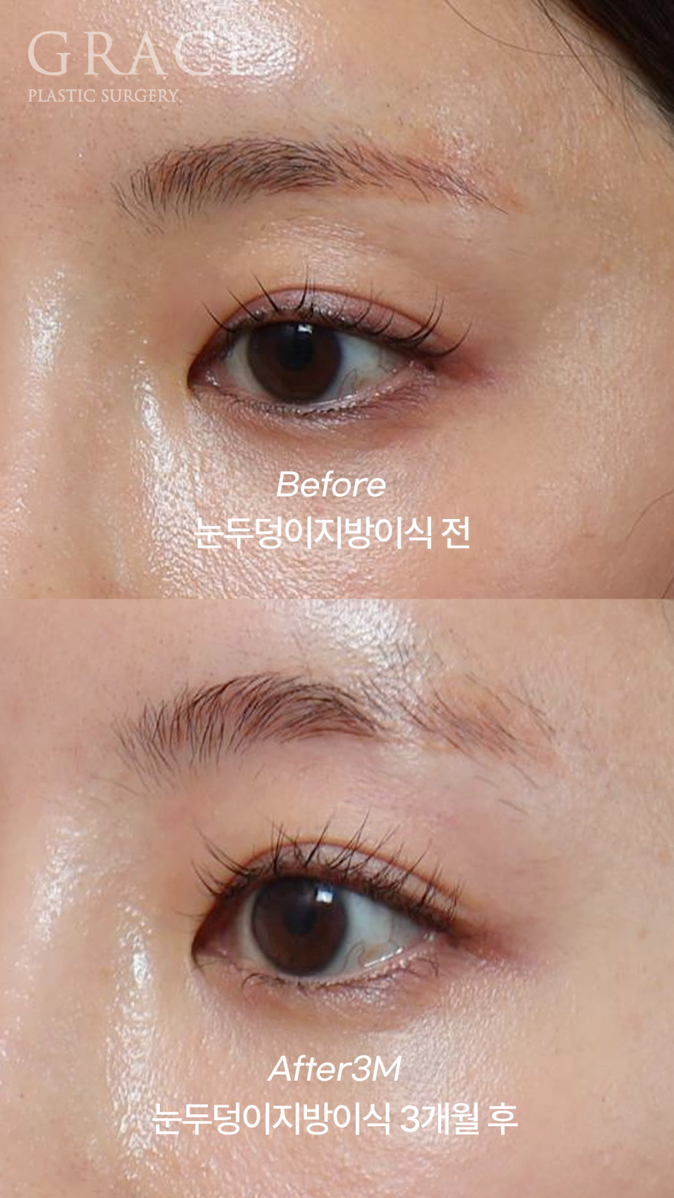 Why Eyelid Hollow Fat Grafting and Orbital Fat Injection Are Important: From Duration of Results to How to Prevent Bumpy Side Effects image 7