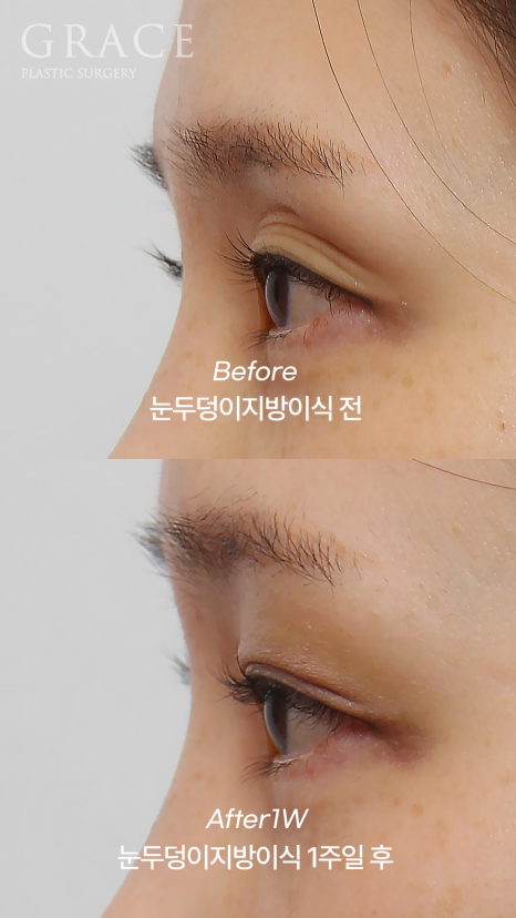 Will Eye Hollow Fat Grafting Really Deflate After 1 Month? 1-Week vs 2-Month Before-and-After Comparison image 5