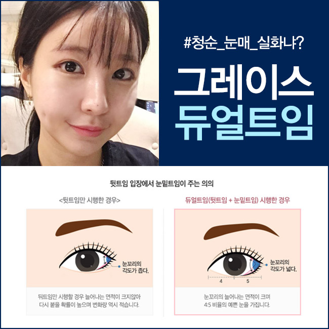 듀얼트임으로 선하고 예쁜눈매를 원한다면? 그레이스성형외과로 가즈아!! 관련 이미지 3