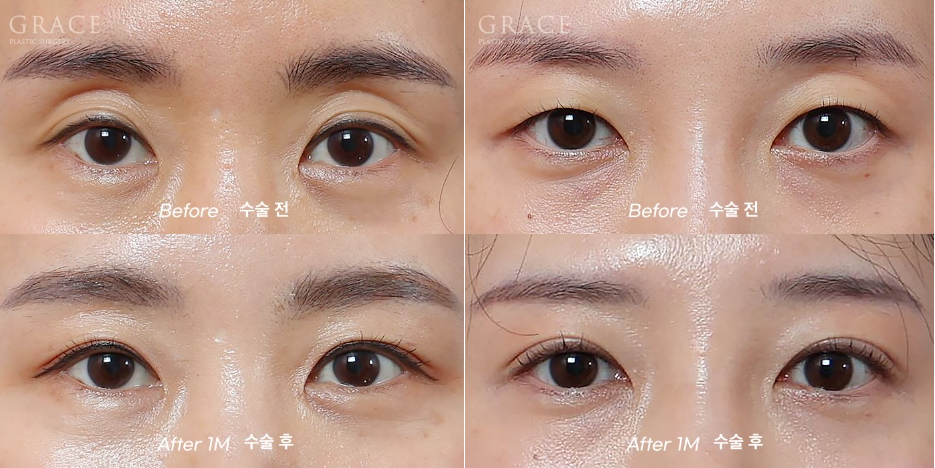 The Basis for a 94.5% Functional Improvement: Fat Grafting Technology That Fills in a Sunken Eye Hollow image 7