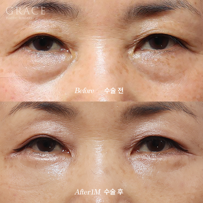 Side Effects of Under-Eye Fat Repositioning? Common Traits of People Who Say It Went Wrong image 1