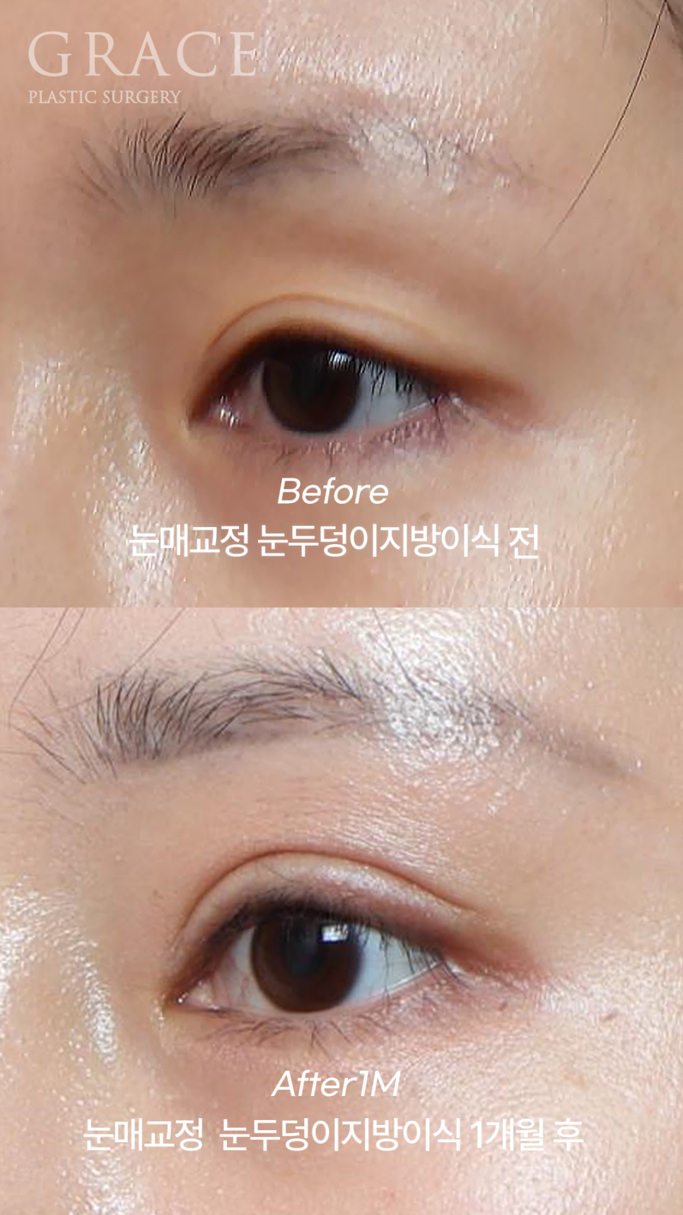 20대 후반 절개눈매교정+눈꺼풀지방이식 관련 이미지 4