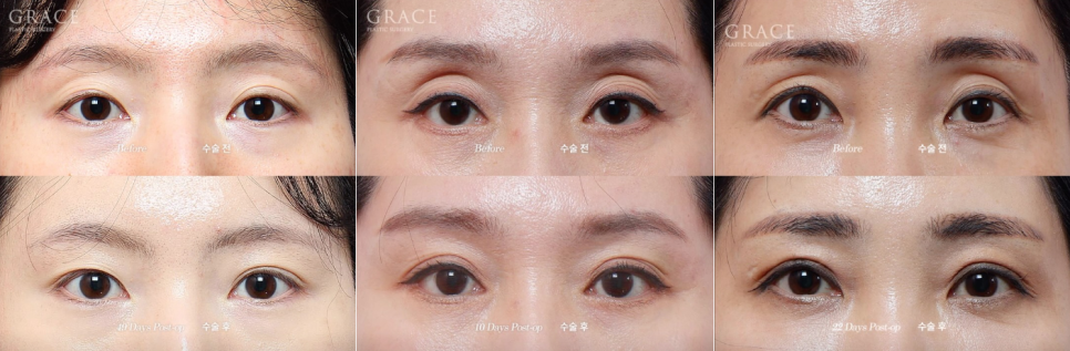 Looking into the Cost of Upper Eyelid Fat Grafting? What Really Matters Is More Than the Price..... image 4