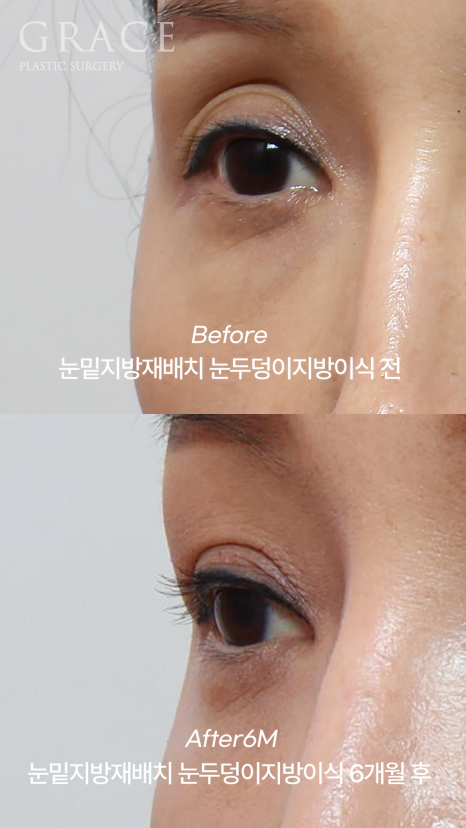 Eye Surgery for People in Their 50s That Reduces Time, Cost, and Recovery: Upper Eyelid Fat Grafting & Under-Eye Fat Repositioning image 2