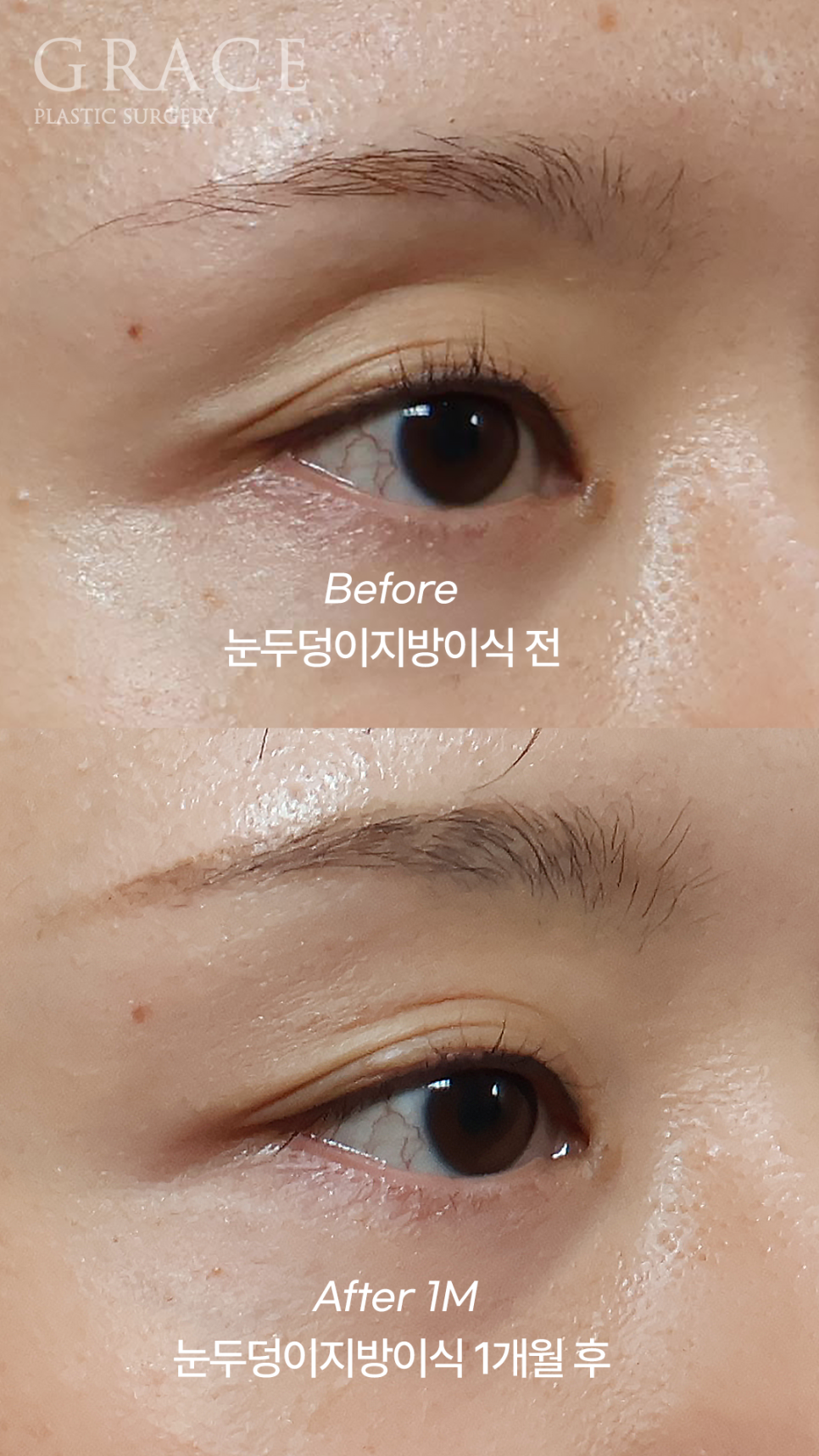 눈꺼풀 지방이식 부작용 왜 생기는지 아시나요? 관련 이미지 4