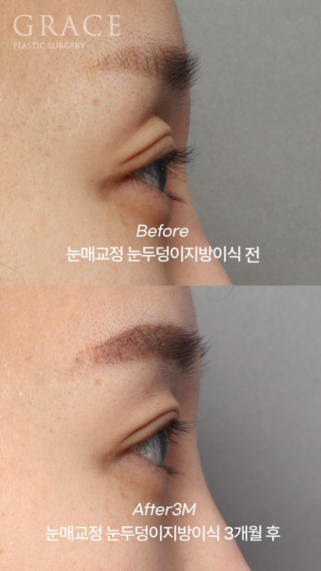 실패한 돌출눈성형 (눈매교정과 눈두덩이 지방이식) 관련 이미지 6