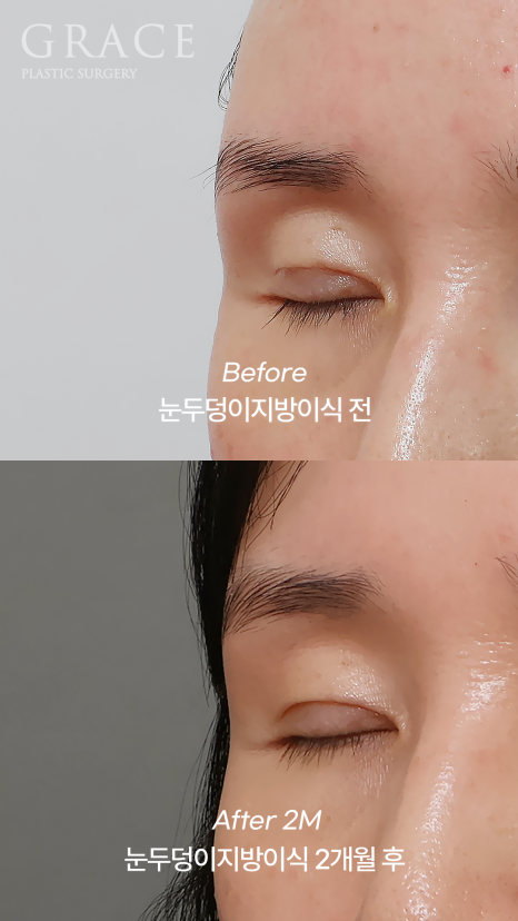 Why Do Hollow Eyelids Occur, and How Can They Be Naturally Improved? (Research Notes from a Doctor Performing Eyelid Fat Grafting) image 4