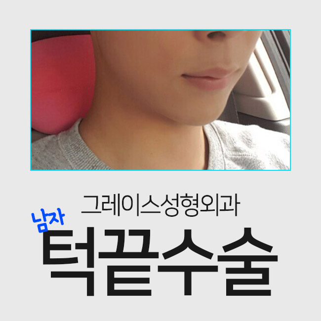 턱끝수술로 남성미를 더하다 관련 이미지 4