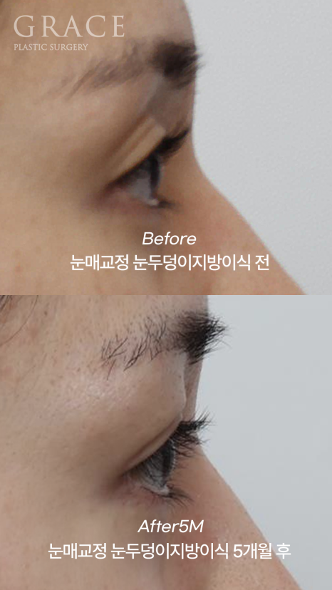 How to Fix a Sunken Eye Hollow: Upper Eyelid Fat Grafting + Ptosis Correction image 2