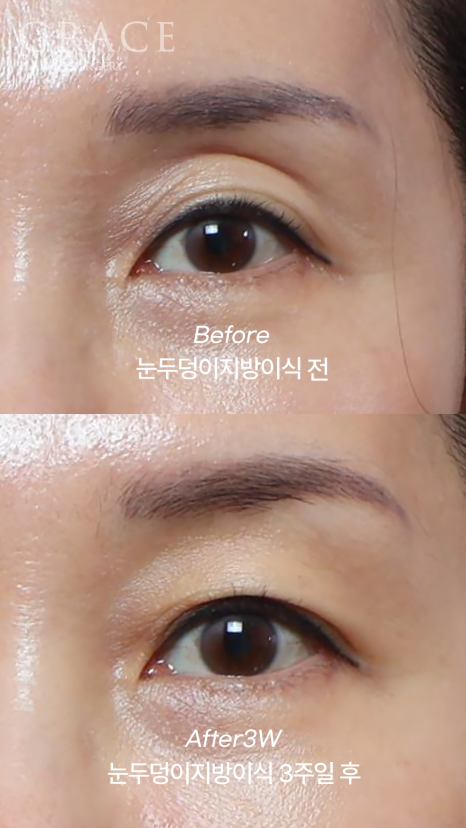 Celebrities with Sunken Eye Hollows, Filler Issue? Upper Eyelid Fat Grafting image 7