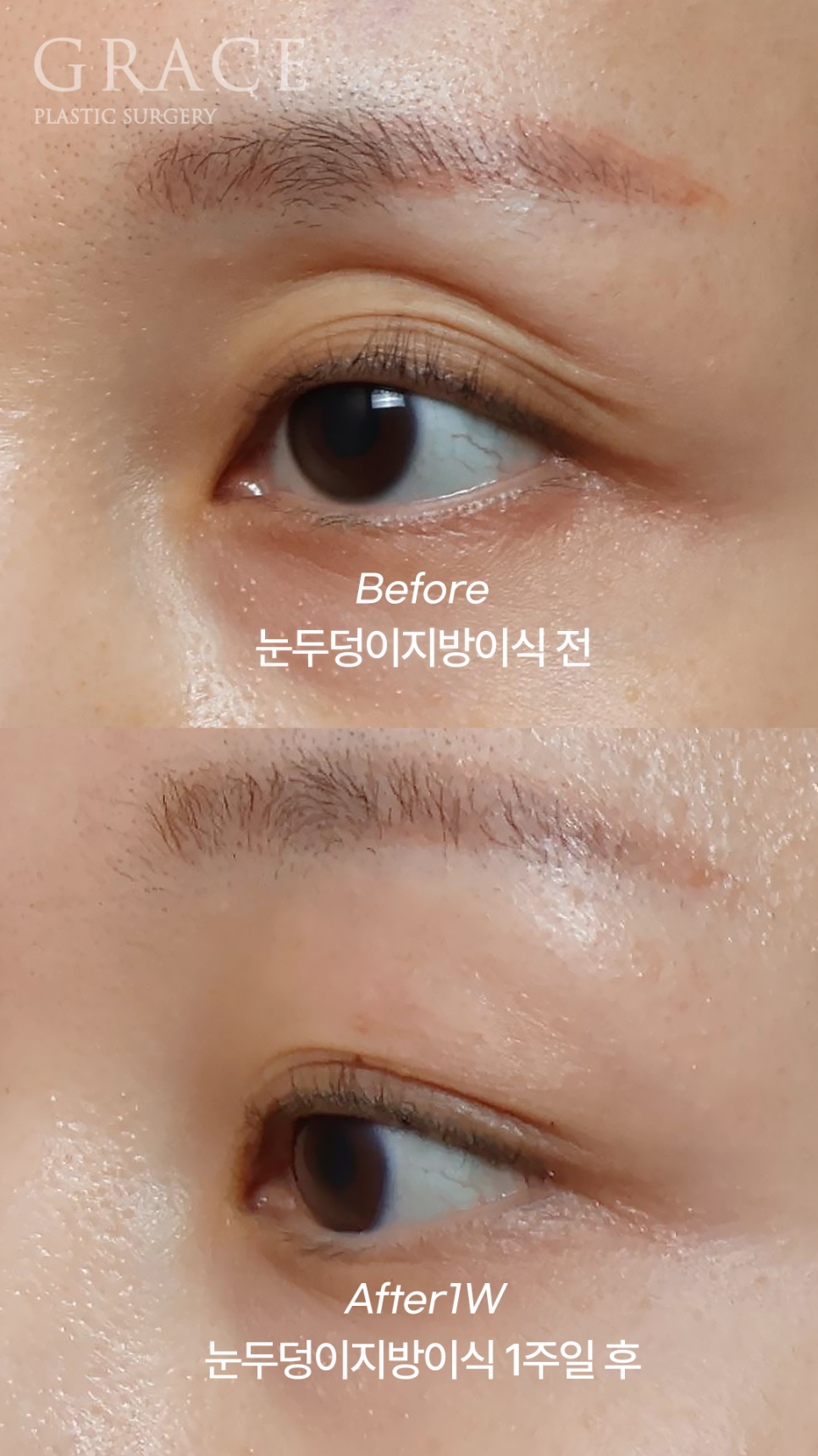 Sunken Eyelid Fat Grafting: Swelling After 1 Week Before & After image 5