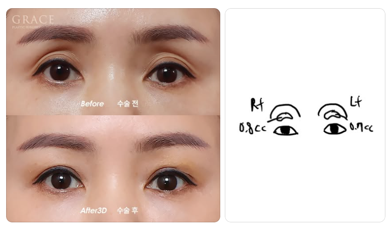 The Real Cause of Side Effects from Upper Eyelid Fat Grafting: the Injection Layer (Orbicularis Oculi Muscle & Orbital Fat) image 8