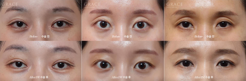 꺼진 아이홀 지방이식 유지기간과 부작용까지 알고 결정해야 하는 이유 관련 이미지 4