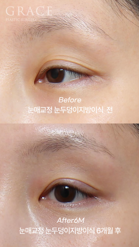 30대 눈꺼풀 지방이식 재꺼짐? 부작용? 6개월 후 관련 이미지 4