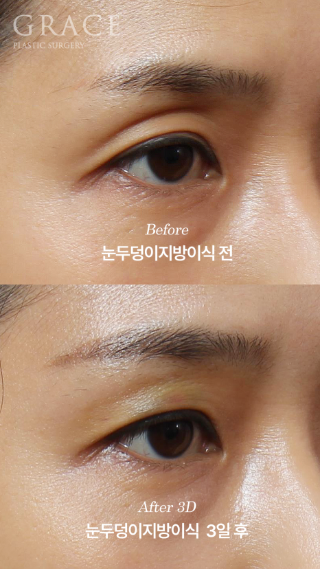 The Most Frequently Asked Symptom After Eyelid Fat Grafting: Yellow Bruising on the Eyelids image 5