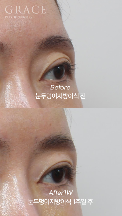 눈두덩이 지방이식 or 풀페이스 지방이식 유지기간&middot;부작용까지 정리 관련 이미지 6