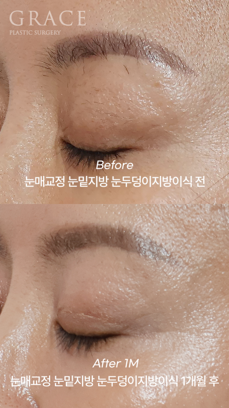 꺼진 아이홀 지방이식, 울퉁불퉁 부작용 오해 바로잡기 관련 이미지 10