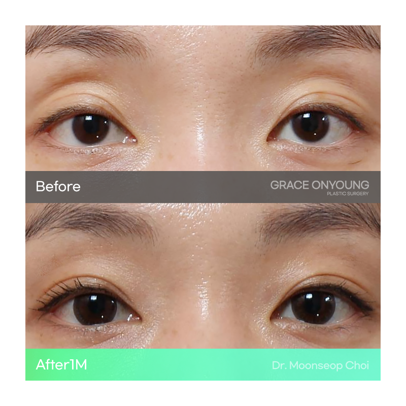 Shocked After Hearing That My Hollow Eyes and Sunken Eye Holes Were Severe? Upper Eyelid Fat Grafting image 3