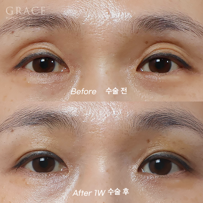 눈두덩이 지방이식 부작용 걱정된다면? 아이홀 지방이식 전후 30대 안와지방이식 관련 이미지 3