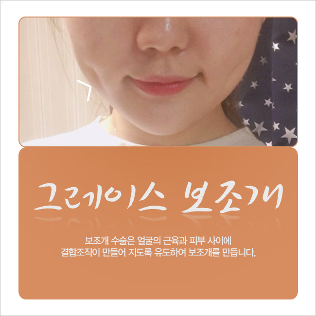 보조개수술 잘하는 곳! 그레이스성형외과 관련 이미지 1
