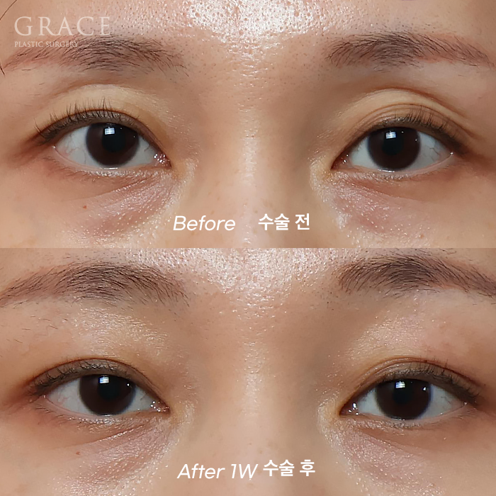 Sunken Eyelid Fat Grafting: Swelling After 1 Week Before & After image 4