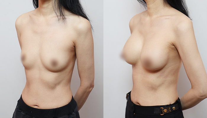 모티바 Demi 300cc│280cc 가슴성형 그레이스성형외과 관련 이미지 3