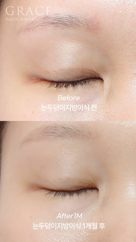 아이홀 꺼짐? 필러 말고 눈꺼풀 지방이식으로 해결했어요 (지방뭉침 없이) 관련 이미지 3