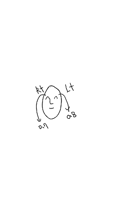 그레이스성형외과 Before&middot;After 아이홀 지방이식 잘하는 곳 관련 이미지 5
