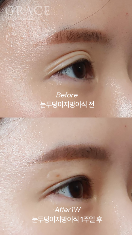 아이홀 꺼짐은 MZ도 예외 없다 눈두덩이 지방이식으로 짝눈교정 관련 이미지 5